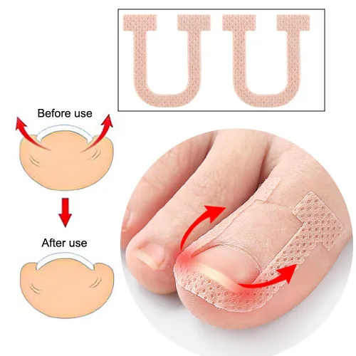 Vista 5 de Paquete de 40 parches correctores de uñas encarnadas en forma de U, correctoras de uñas de los pies, parches de corrección, vendajes para alivio