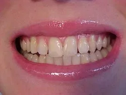 Vista 4 de D.I.Y) 10 thermo-molding "hervir y Bite Boca Bandejas por instantánea blanco Sonrisa mayorista