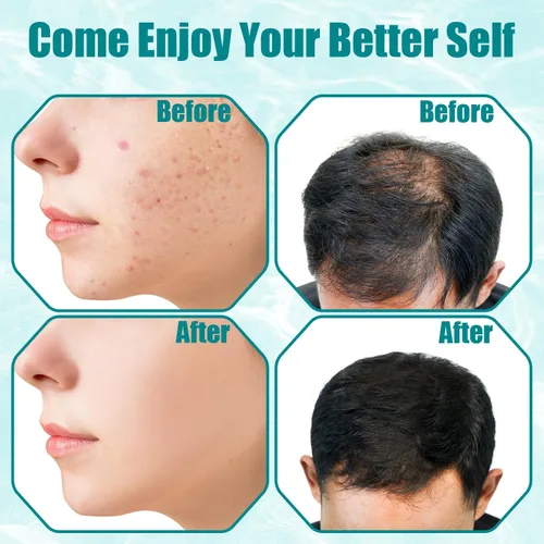 Vista 5 de TUMAKOU - Varita facial de alta frecuencia, máquina portátil de piel facial de alta frecuencia con luz violeta - con 6 tubos de vidrio (blanco)