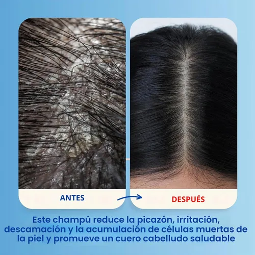 Vista 8 de Mediceuticals X-Folate Shampoo Champú Anticaspa para Mujeres y Hombres – Control Persistente de la Caspa – Para la acumulación de cuero cabelludo