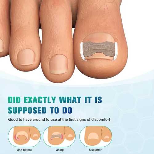 Vista 5 de FERYES Juego de corrector de uñas encarnadas, herramienta profesional de pedicura, 40 tiras alisadoras de uñas encarnadas sin dolor, 50 parches
