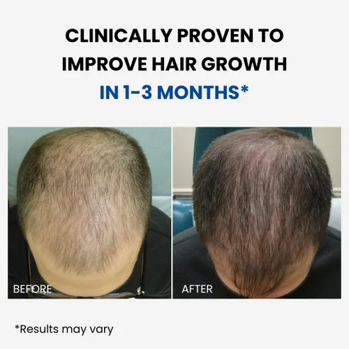 Vista 2 de ForHair - Aerosol para el crecimiento del cabello para hombres – Estimula el cabello nuevo, fortalece los folículos – Acción de recrecimiento local