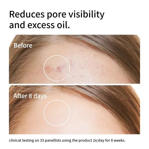 Vista 5 de Suero facial de niacinamida 10% + zinc 1% Control avanzado del tono de la piel y el aceite Fórmula hidratante y antimanchas Ligero y de rápida