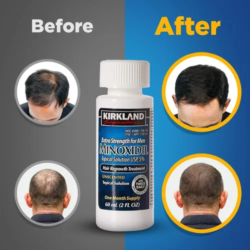 Vista 2 de Minoxidil - Solución tópica al 5% para hombres, tratamiento extra fuerte para el crecimiento del cabello, aplicador con cuentagotas incluido