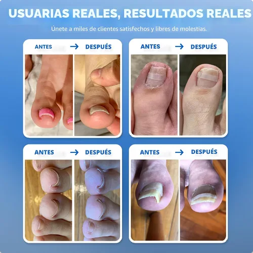 Vista 3 de Tratamiento del hogar para uñas encarnadas CurveCorrect