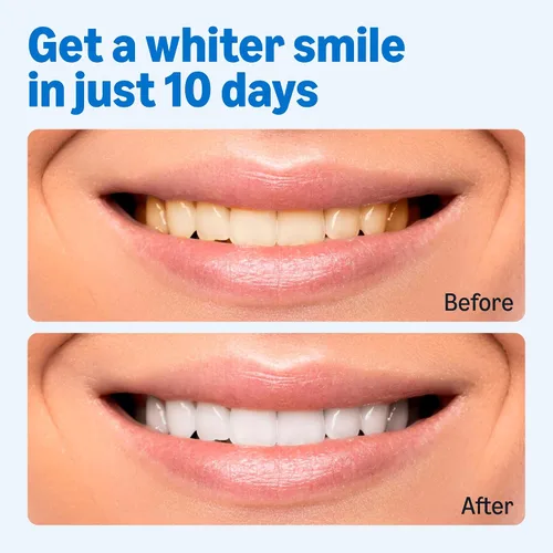 Vista 4 de Amazon Basics Kit de tiras blanqueadoras de dientes de 10 días, 10 tratamientos, 1 paquete (anteriormente Solimo)