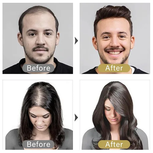 Vista 5 de Minoxidil para hombres y mujeres, suero de crecimiento del cabello mejorado al 5%, tratamiento de crecimiento del cabello para adelgazamiento