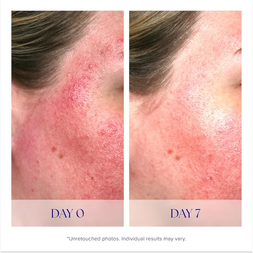 Vista 4 de iS CLINICAL Pro-Heal Serum Advance+ - Suero de vitamina C rico en antioxidantes, calma la sensibilidad y la irritación, ayuda al enrojecimiento
