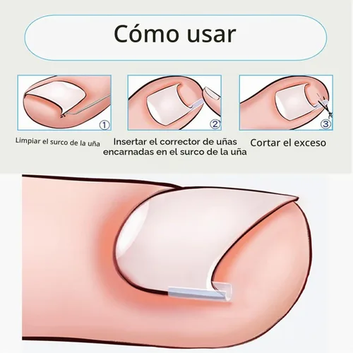 Vista 7 de Kit de tiras correctoras de uñas encarnadas, 10 piezas de tiras correctoras de uñas encarnadas, tiras alisadoras de uñas encarnadas, clips