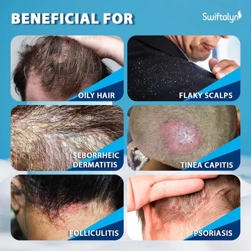 Vista 6 de Champú antifúngico para dermatitis seborreica y foliculitis: Psoriasis, Caspa y Champú Ance del Cuero Cabelludo para Hombres y Mujeres – Alivia