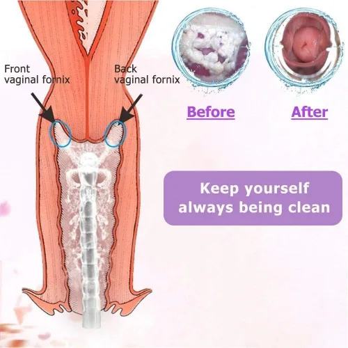 Vista 4 de Sistema de Limpieza Vaginal Reutilizable Excelente Limpiador Vaginal Enjuague Vaginal Femenino, Limpieza Manual con Presión, 100% Seguro, Capacidad