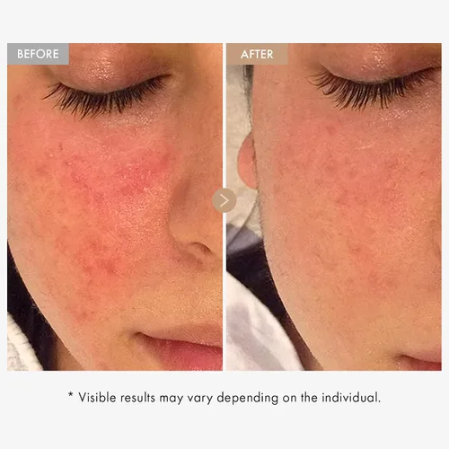 Vista 3 de TOSOWOONG Crema de Avena Real para Alivio, Hidratante Facial Diario, Cuidado para Manchas, Recuperación Calmante, Humectación, Avena Coloidal