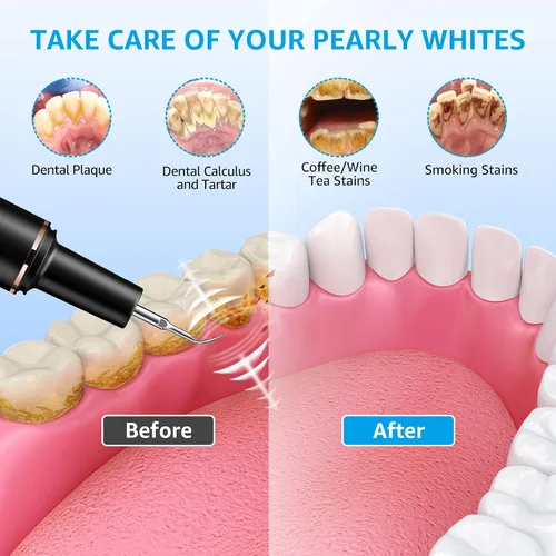 Vista 8 de Kit de limpieza de dientes, removedor de placa para dientes, herramienta portátil para quitar placa dental con LED, blasador de placa para dientes
