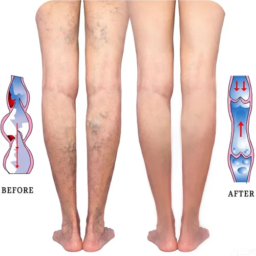 Vista 4 de Lin Performance - Medias de compresión médica de 15-20 mmHg para mujeres y hombres, altas hasta el muslo, con punta abierta y detalle de puntos