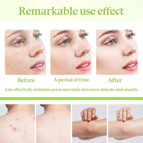 Vista 4 de 3 unidades de gel exfoliante suave, exfoliante facial hidratante, gel de limpieza profunda para cara y cuerpo, exfoliante facial no graso