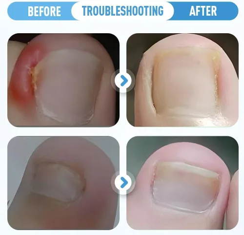 Vista 2 de Juego de corrector de uñas encarnadas, tiras correctoras de uñas curvas, lima sin dolor y herramientas de pedicura levantador para mujeres y hombres