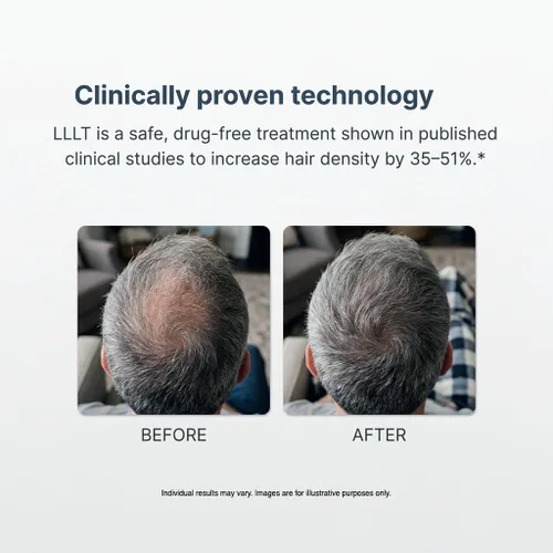 Vista 3 de Alpha Hair Growth Laser Cap (136 láseres) Dispositivo de crecimiento láser aprobado por la FDA para hombres y mujeres, tecnología láser SMT, salida
