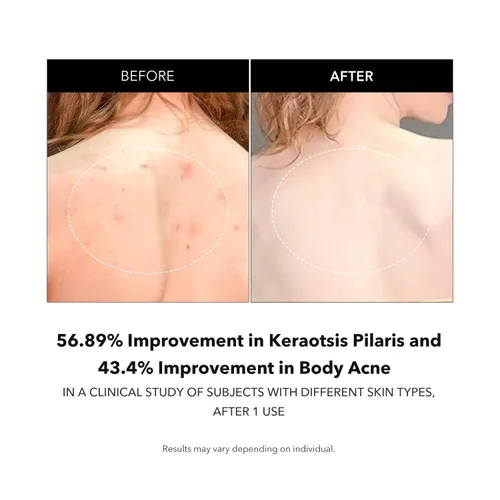 Vista 4 de APRILSKIN Carrotene IPMP Gel de baño exfoliante Gel de baño de ácido salicílico mejora la piel áspera y con baches, acné corporal, queratosis