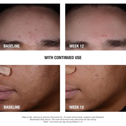 Vista 3 de Neutrogena Stubborn Blackheads - Suero facial diario para acné con ácidos salicílico, glicólico, polihidroxi y mandélico, suero facial sin aceite