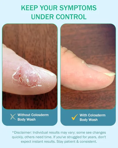 Vista 6 de Eczema Cream Gel de baño para piel sensible para mujeres y hombres, gel de baño hidratante con calostro y avena coloidal, limpiador suave para piel