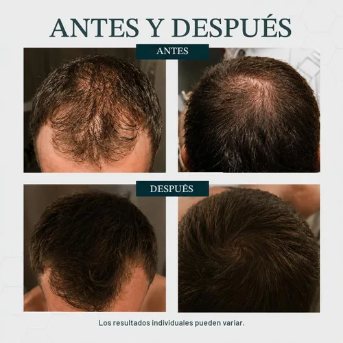 Vista 7 de Champú DR para tratamiento del cabello y del cuero cabelludo, de Regenepure, individual