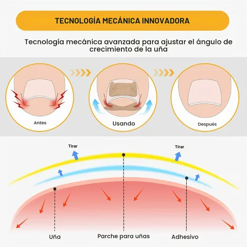 Vista 3 de BEZOX 60 parches correctores de uñas encarnadas transpirables y 50 calcomanías para uñas encarnadas – Cinta de uñas encarnadas