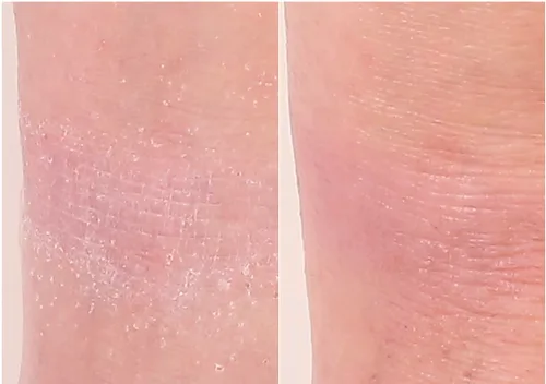 Vista 4 de Nakery Tratamiento de reparación intensiva para aliviar el eccema crema calmante para rostro y cuerpo 2% de avena coloidal Alivio inmediato