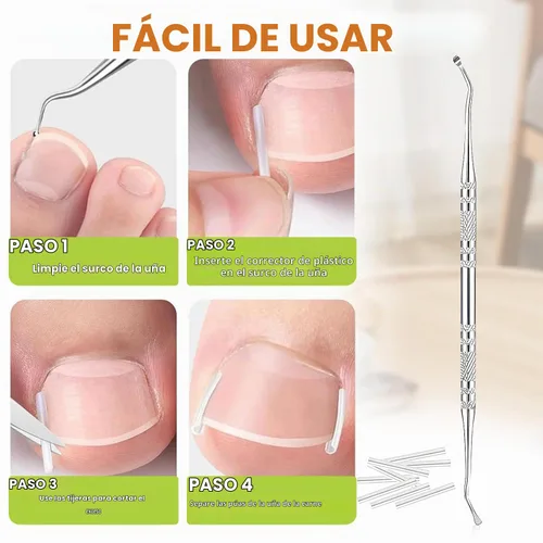 Vista 2 de Kit corrector de uñas encarnadas, herramientas de uñas, tiras de corrección transpirables con herramientas de levantamiento de uñas, cortaúñas