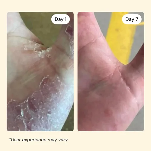 Vista 5 de MyMagicHealer Universal Flare Care Sin aceite esencial Alivio para erupciones, eczema, psoriasis, hidradenitis supurativa, impétigo, dermatitis