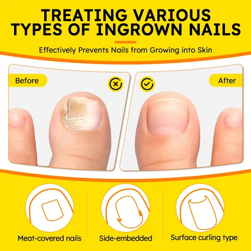 Vista 7 de Tratamiento de uñas encarnadas, corrector de uñas curvadas transpirables, tiras correctoras de uñas encarnadas con lima y levantador, kit
