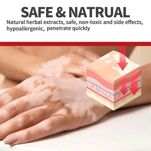 Vista 5 de Spray de tratamiento de vitíligo, tratamiento de vitíligo natural para la piel, mejora la pigmentación de la piel, crema de vitíligo adecuada