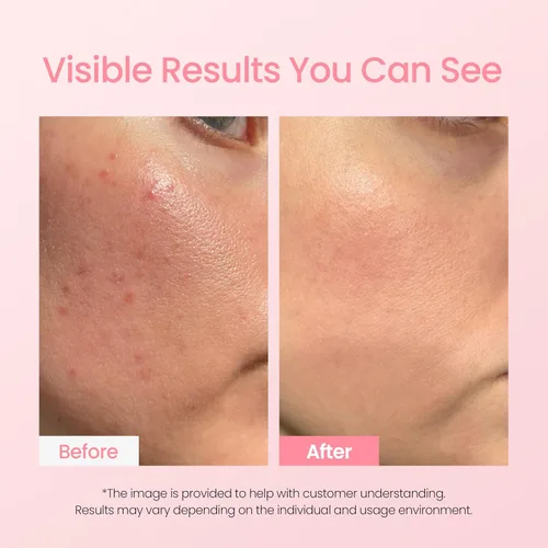 Vista 5 de NEOGEN A-Clear - Borrador rosa calmante para el cuidado de manchas, cuidado de manchas, cuidado de la piel coreana, poder de secado de espinillas