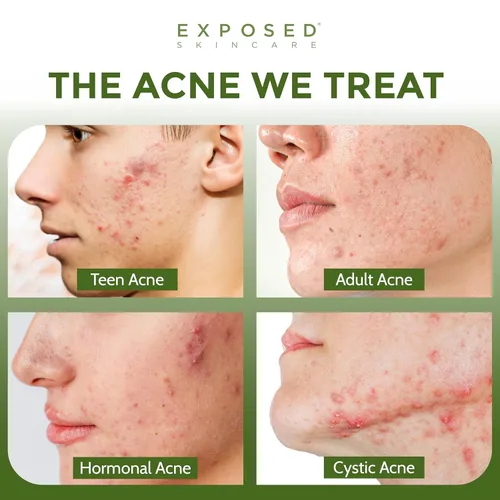Vista 2 de Exposed Skin Care Mascarilla facial de carbón activado para purificar la piel, regular la producción de aceite y minimizar visiblemente los poros
