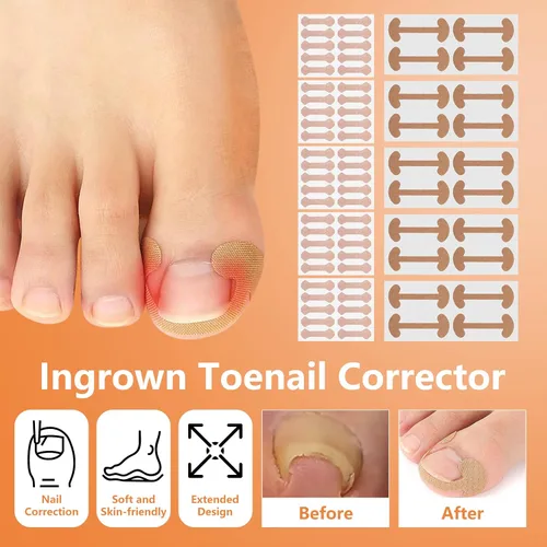 Vista 4 de Juego de corrector de uñas encarnadas con tiras correctoras, juego profesional de herramientas de pedicura para uñas encarnadas para hombres