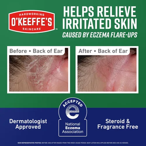 Vista 3 de O'Keeffe's Crema corporal reparadora de la piel para aliviar el eccema, tubo de 7 onzas (paquete de 1) – Alivio de la picazón de 48 horas en un solo