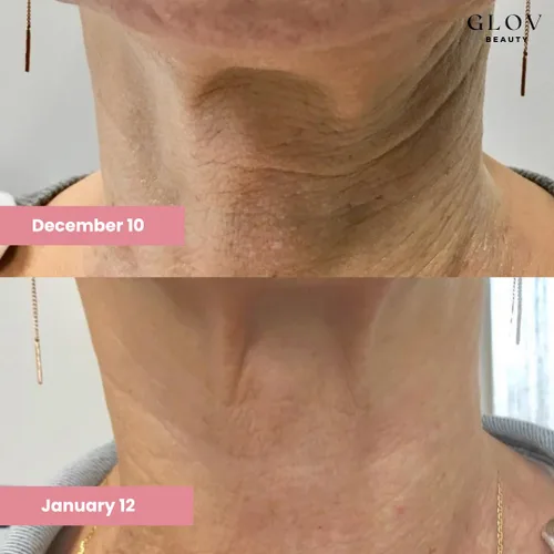 Vista 3 de Glov Beauty - Crema para el cuello Lift & Firm - Crema antienvejecimiento para cuello y escote para arrugas, flacidez de la piel y estiramiento