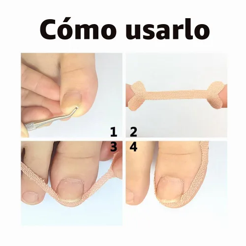 Vista 3 de Tratamiento de uñas encarnadas, 50 parches correctores de uñas encarnadas, calcomanías de corrección de uñas de los pies, herramienta profesional