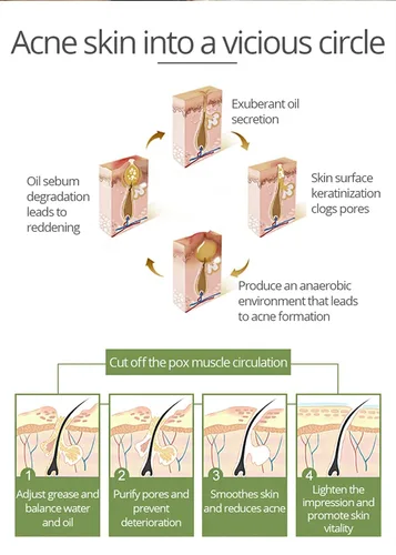 Vista 4 de AICHUN BEAUTY El ácido salicílico del extracto del aloe vera del suero facial anti-acné repara la piel dañada 1.0 fl oz