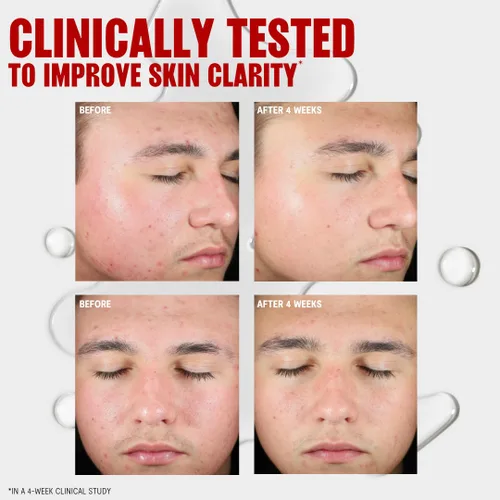 Vista 5 de Thayers Blemish Clearing - Tónico de ácido salicílico, tóner facial para tratamiento del acné con ácido salicílico al 2%, cuidado de la piel