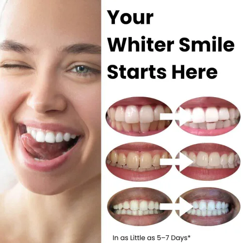 Vista 5 de Flexfit™ Bandejas blanqueadoras de dientes precargadas - Blanqueador dental profesional con peróxido de hidrógeno al 12%, tecnología Dryfit™ lista