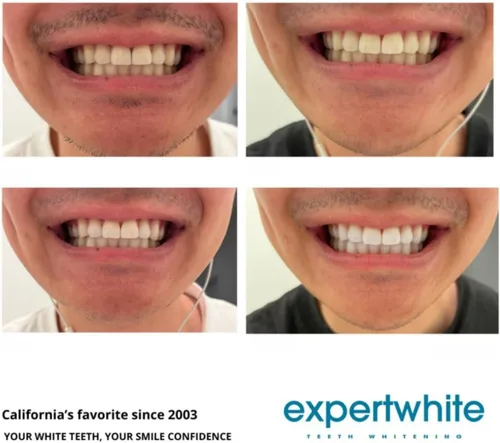 Vista 6 de MaxStrips™ Tiras blanqueadoras de dientes al 12% – Tiras blanqueadoras profesionales de peróxido al 12%, tecnología Dryfit antideslizante, seguro