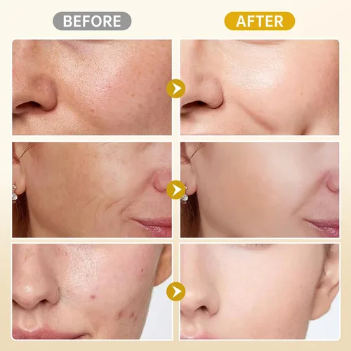 Vista 5 de BOLI Crema de ácido kójico, removedor de manchas oscuras, ácido azelaico + ácido salicílico + niacinamida + péptidos de retinol crema para la piel