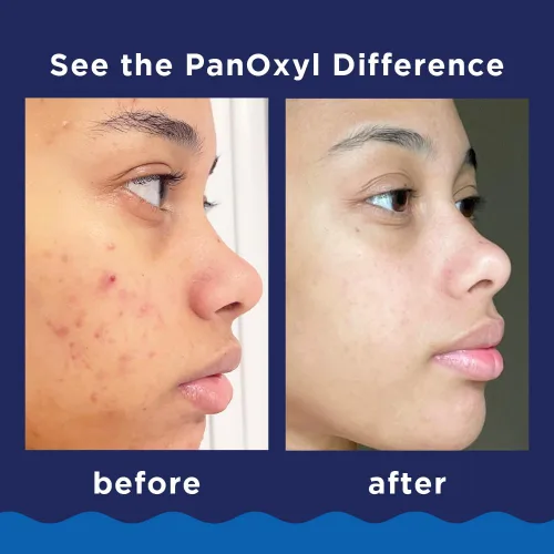 Vista 3 de PanOxyl Paquete de dúo nocturno – Lavado espumoso para acné peróxido de benzoilo 10%, parches de manchas durante la noche PM