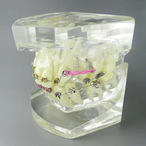 Vista 4 de Modelo dental de los dientes del tratamiento de ortodoncia de la maloclusión con los soportes del metal Alambres Cadenas y aros coloridos