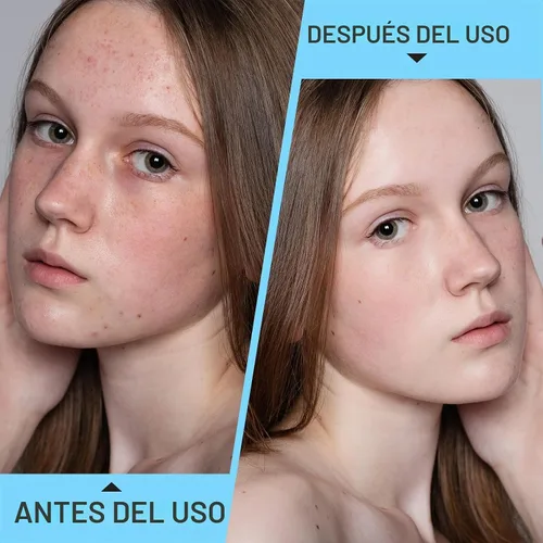 Vista 6 de Kit profesional para eliminar espinillas, 100 agujas desechables para el acné, herramientas para eliminar puntos negros, herramienta extractora