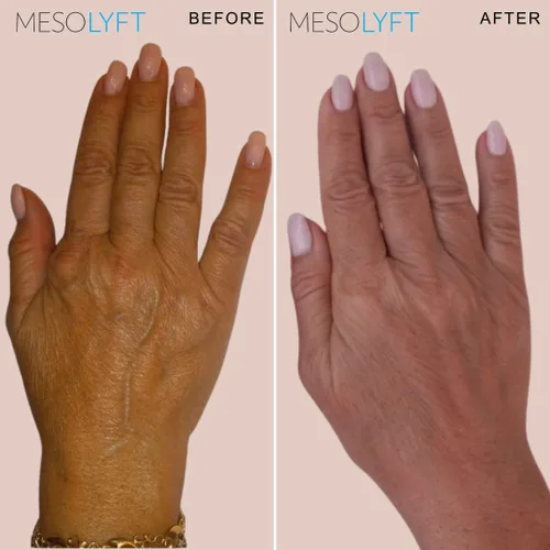 Vista 5 de Combo de guantes rejuvenecedores y máscara - Portátil y recargable - Calor infrarrojo para arrugas, guantes antienvejecimiento con máscara