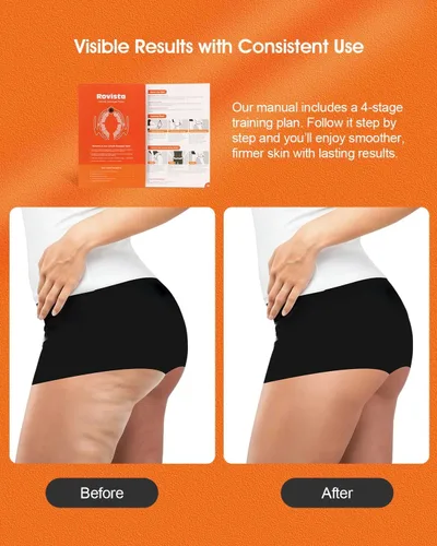 Vista 4 de Herramienta de masaje anticelulitis – Removedor ergonómico de celulitis para piernas y brazos con asas desmontables – Masajeador de drenaje