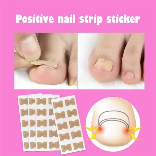 Vista 9 de Parche de corrección de uñas encarnadas, 50 calcomanías de uñas encarnadas sin pegamento para uñas encarnadas curvadas para el cuidado de los pies