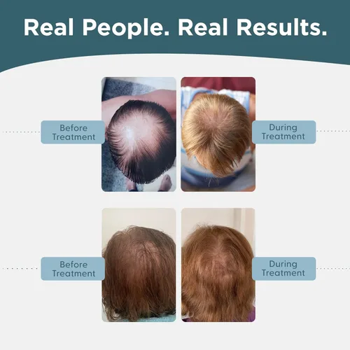 Vista 7 de Shapiro MD Hair Growth Experts Minoxidil Solución tópica al 5% para el crecimiento del cabello de los hombres, el suero promueve el crecimiento