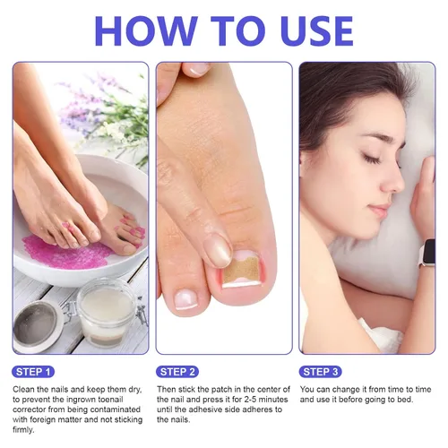 Vista 7 de Parche corrector de uñas encarnadas, 100 tiras correctoras de uñas encarnadas, parches de corrección de uñas de los pies, herramienta de tratamiento